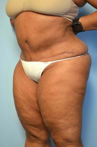 Tummy Tuck Before & After Gallery - Patient 745304 - Image 8