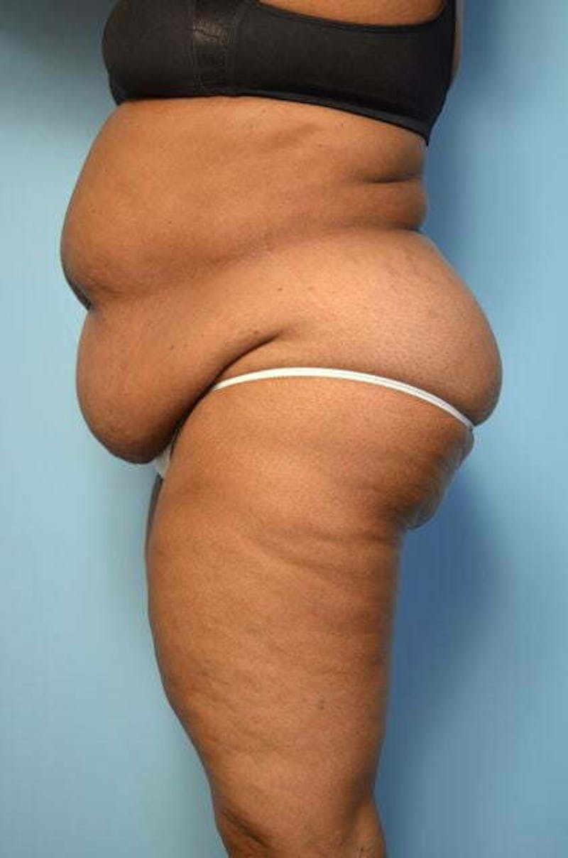 Liposuction Before & After Gallery - Patient 425554 - Image 9