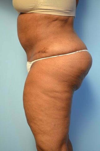 Tummy Tuck Before & After Gallery - Patient 745304 - Image 10