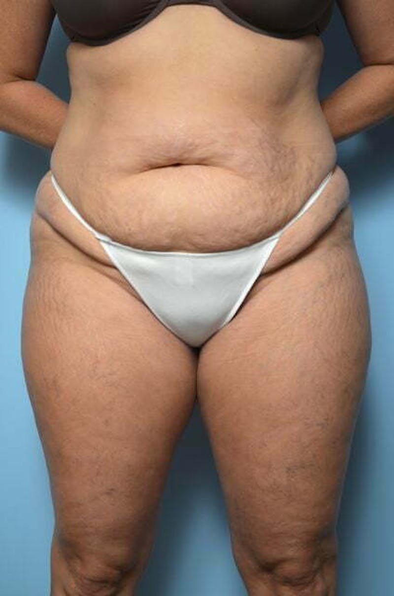 Liposuction Before & After Gallery - Patient 214207 - Image 1