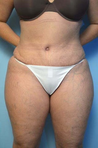 Tummy Tuck Before & After Gallery - Patient 309735 - Image 2