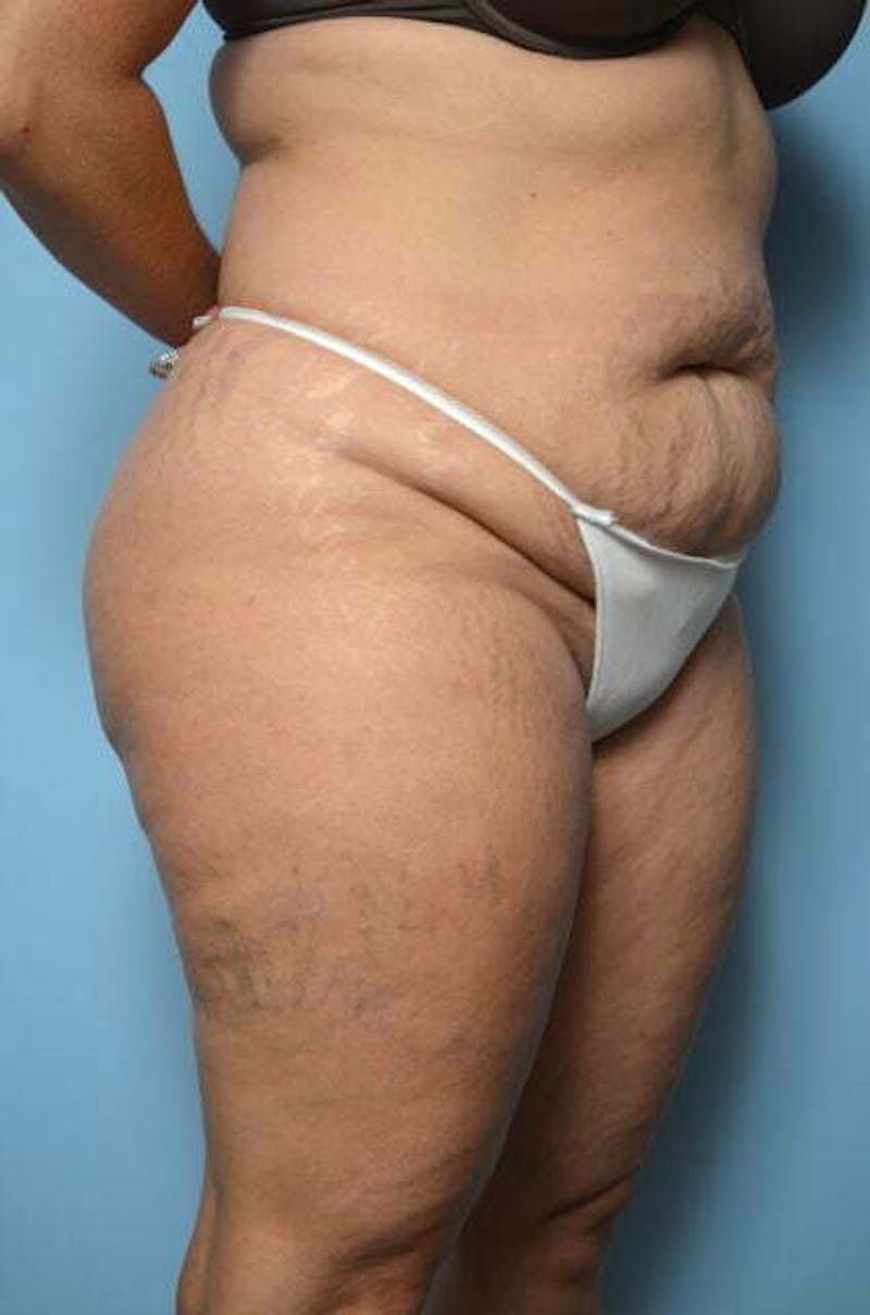 Liposuction Before & After Gallery - Patient 214207 - Image 3