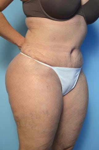 Tummy Tuck Before & After Gallery - Patient 309735 - Image 4