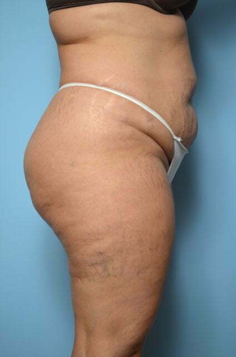 Liposuction Before & After Gallery - Patient 214207 - Image 5