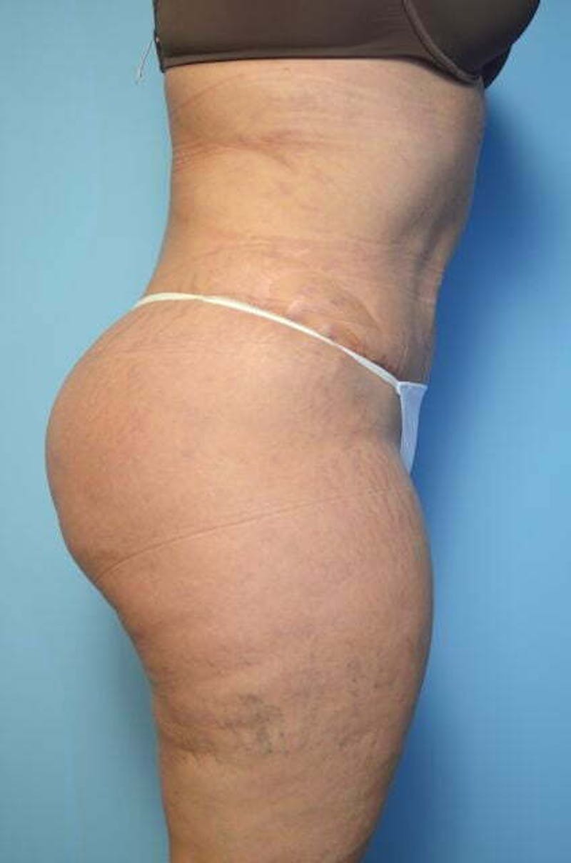 Liposuction Before & After Gallery - Patient 214207 - Image 6