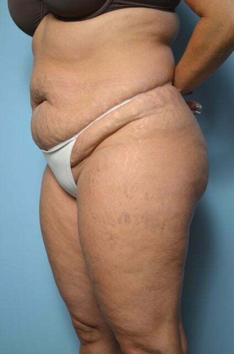Liposuction Before & After Gallery - Patient 214207 - Image 7