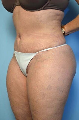 Tummy Tuck Before & After Gallery - Patient 309735 - Image 8