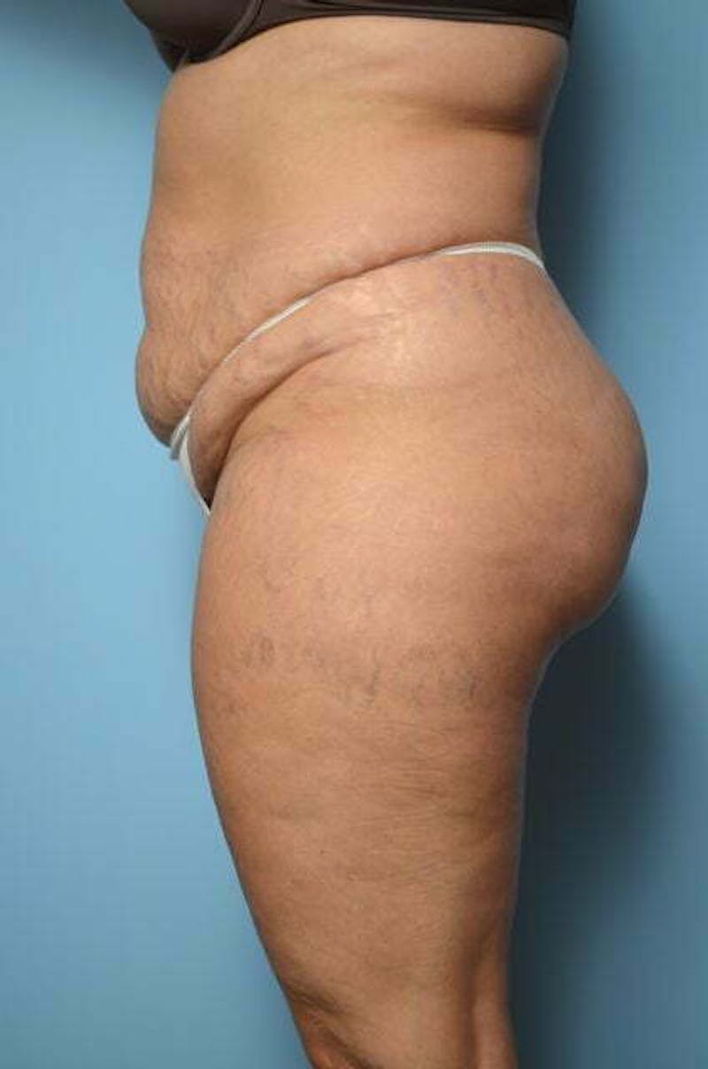 Liposuction Before & After Gallery - Patient 214207 - Image 9