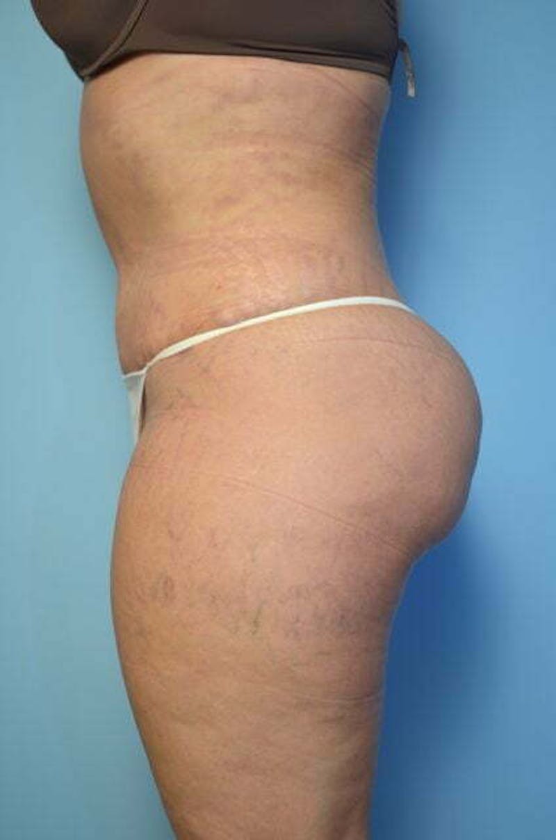 Liposuction Before & After Gallery - Patient 214207 - Image 10