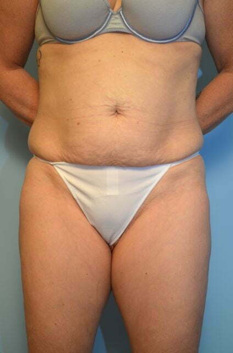 Tummy Tuck Before & After Gallery - Patient 279957 - Image 1