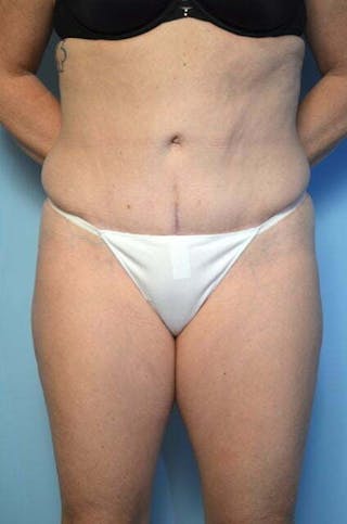 Tummy Tuck Before & After Gallery - Patient 279957 - Image 2