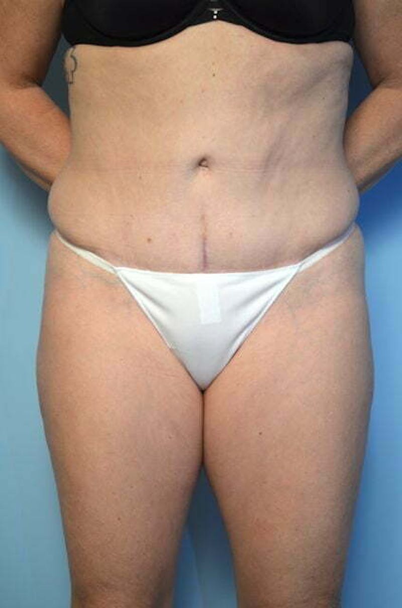 Tummy Tuck Before & After Gallery - Patient 279957 - Image 2