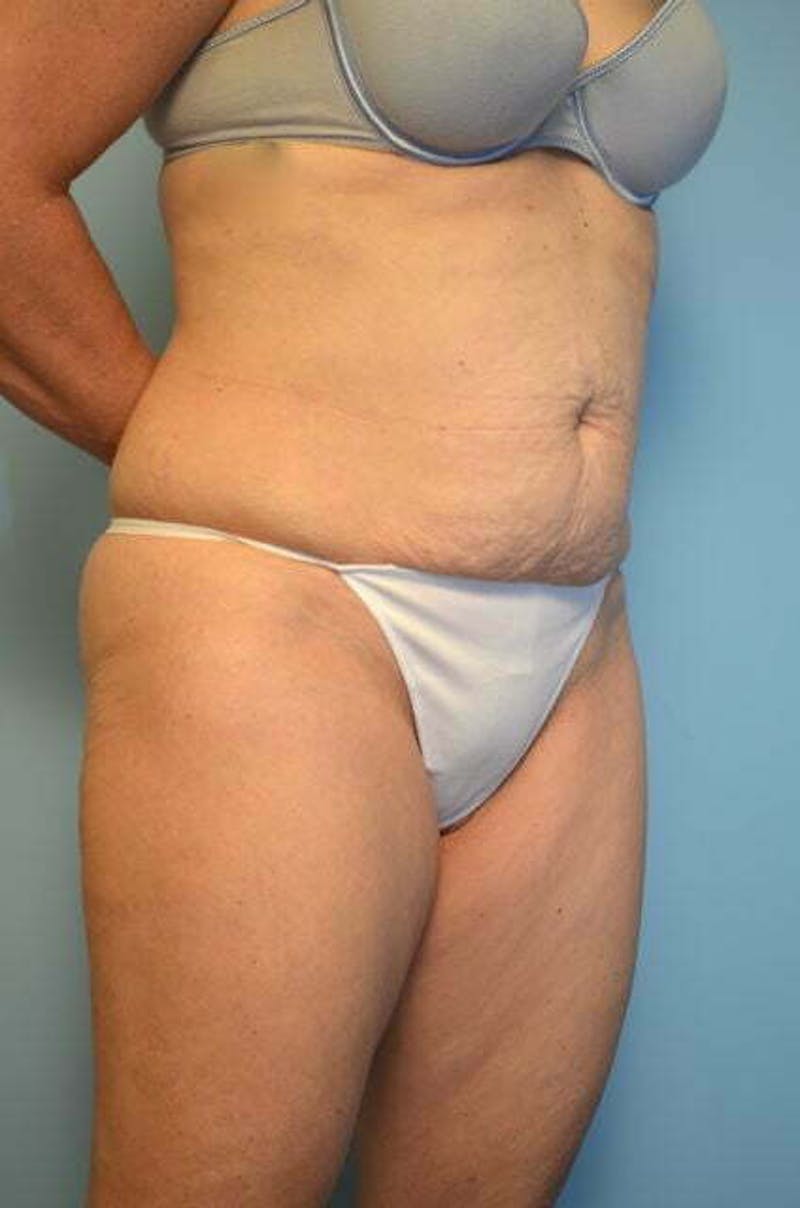 Tummy Tuck Before & After Gallery - Patient 279957 - Image 3