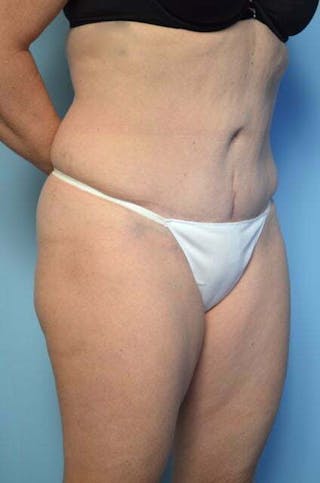 Tummy Tuck Before & After Gallery - Patient 279957 - Image 4