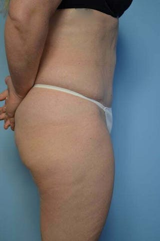 Tummy Tuck Before & After Gallery - Patient 279957 - Image 6