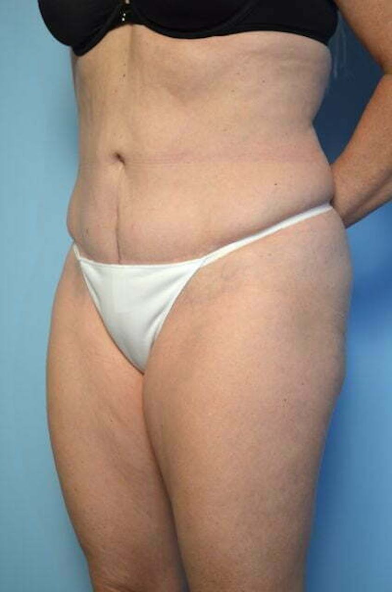 Tummy Tuck Before & After Gallery - Patient 279957 - Image 7