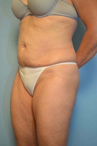 Tummy Tuck Before & After Gallery - Patient 279957 - Image 8