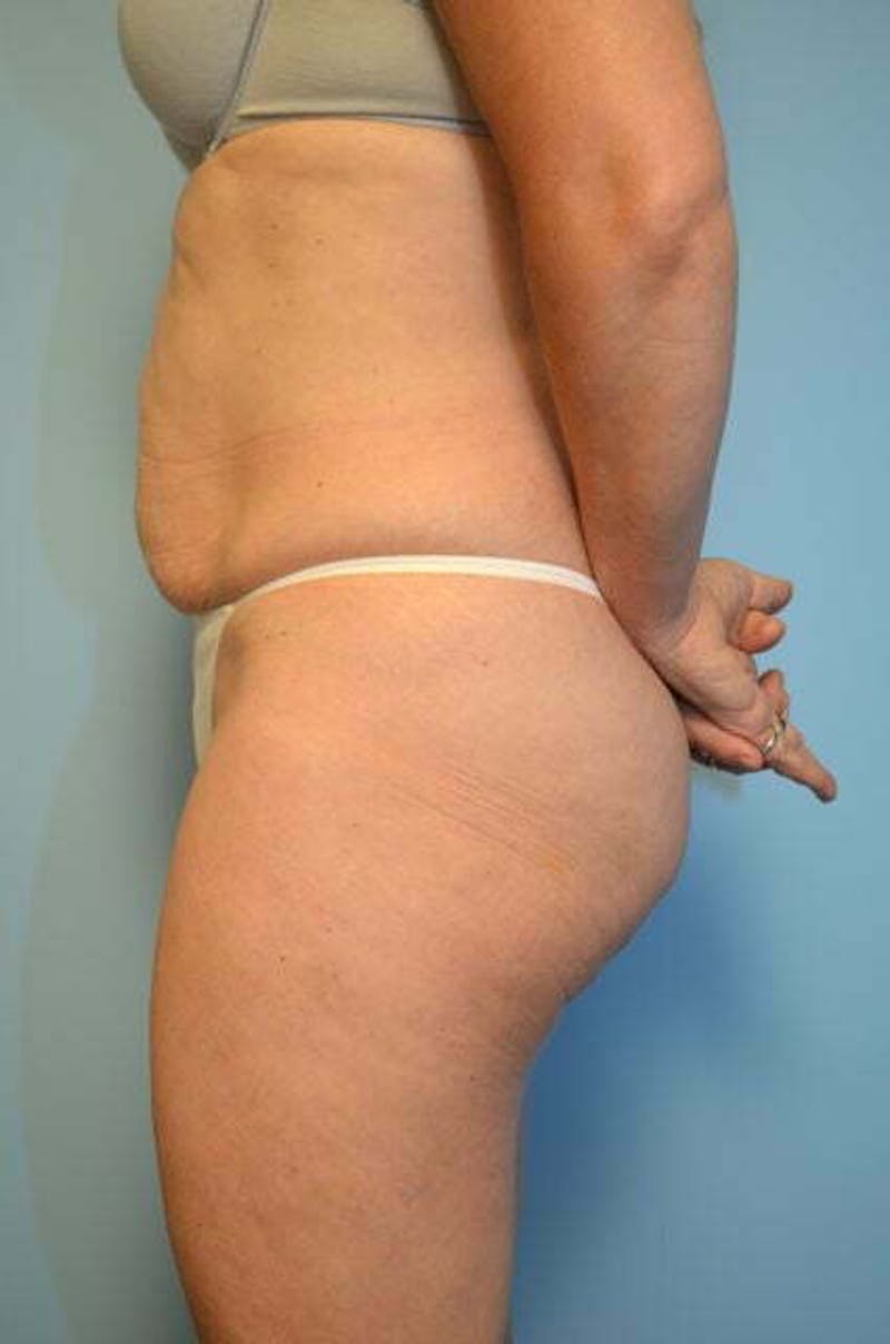 Tummy Tuck Before & After Gallery - Patient 279957 - Image 9