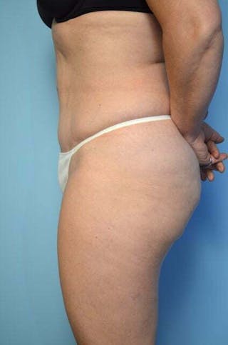 Tummy Tuck Before & After Gallery - Patient 279957 - Image 10