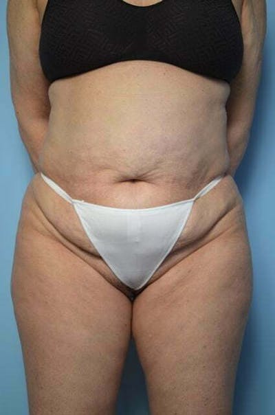 Liposuction Before & After Gallery - Patient 391522 - Image 1