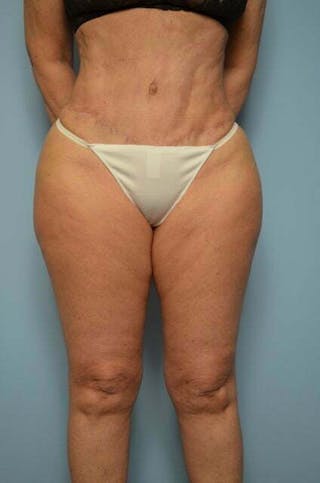 Tummy Tuck Before & After Gallery - Patient 185408 - Image 2