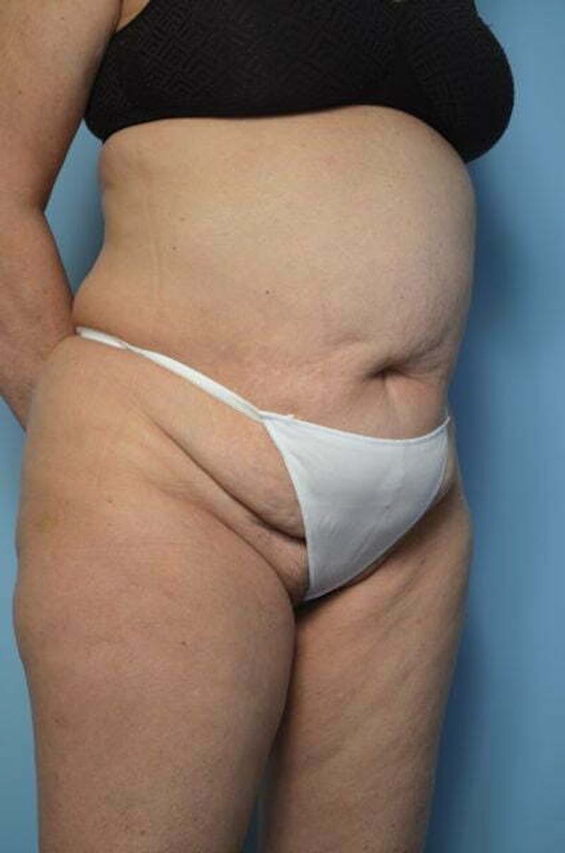 Tummy Tuck Before & After Gallery - Patient 185408 - Image 3