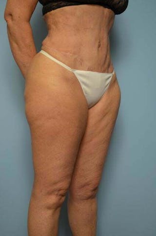 Tummy Tuck Before & After Gallery - Patient 185408 - Image 4