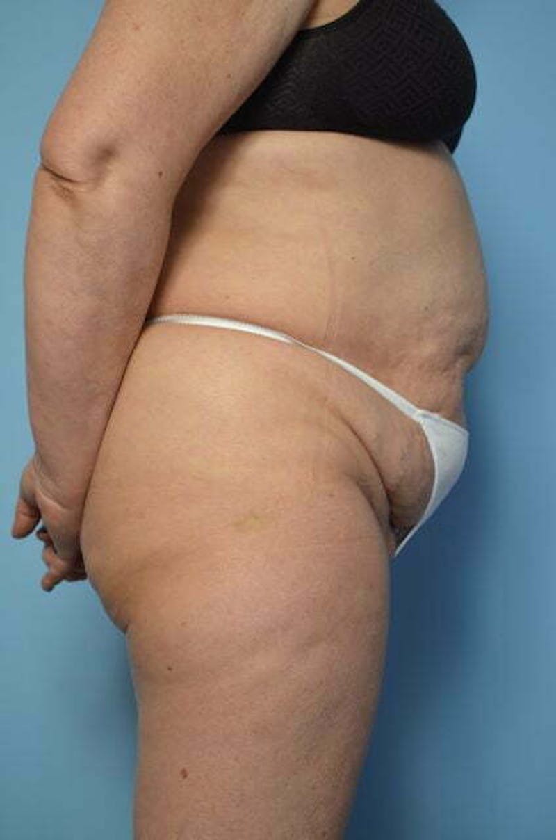 Tummy Tuck Before & After Gallery - Patient 185408 - Image 5