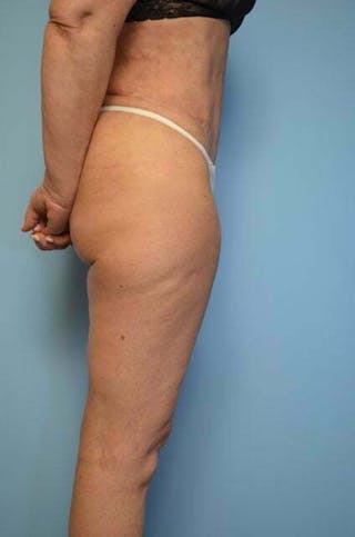Tummy Tuck Before & After Gallery - Patient 185408 - Image 6