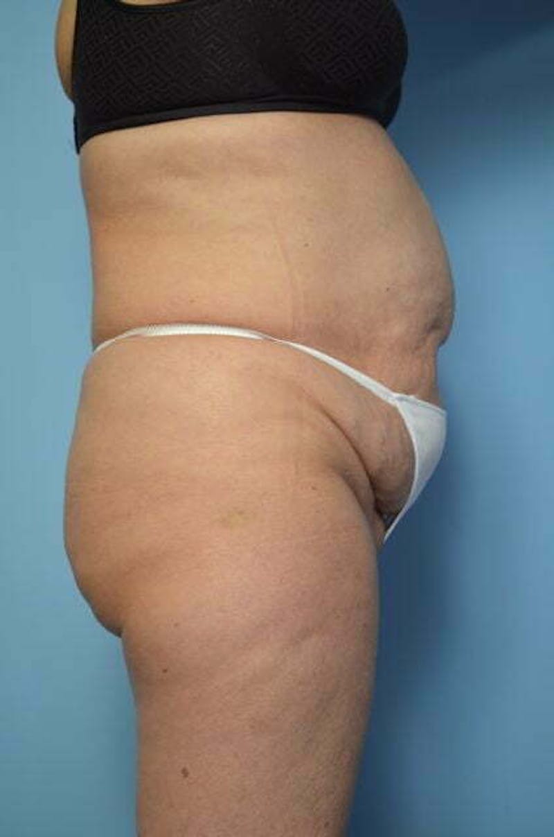 Tummy Tuck Before & After Gallery - Patient 185408 - Image 7