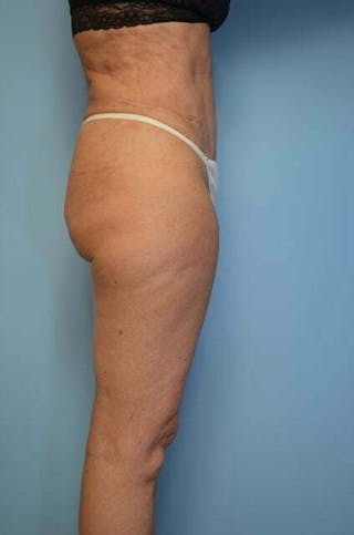 Tummy Tuck Before & After Gallery - Patient 185408 - Image 8