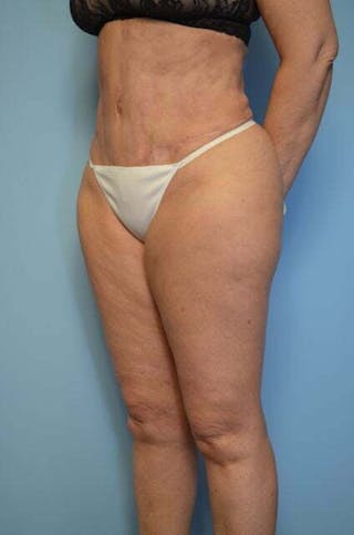 Tummy Tuck Before & After Gallery - Patient 185408 - Image 10