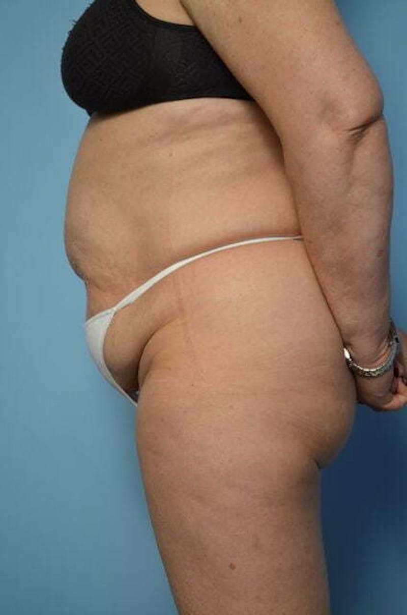Tummy Tuck Before & After Gallery - Patient 185408 - Image 11