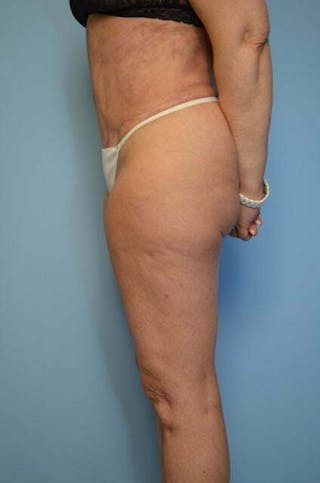 Tummy Tuck Before & After Gallery - Patient 185408 - Image 12