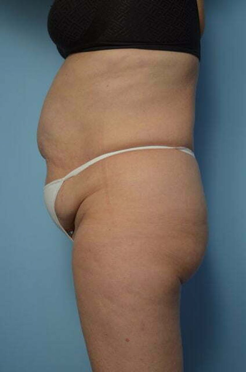 Tummy Tuck Before & After Gallery - Patient 185408 - Image 13