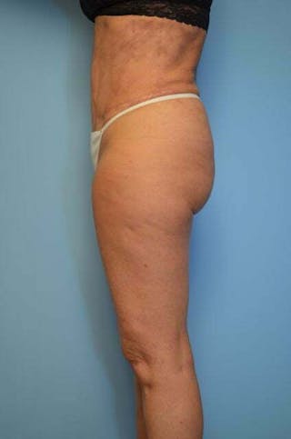 Tummy Tuck Before & After Gallery - Patient 185408 - Image 14