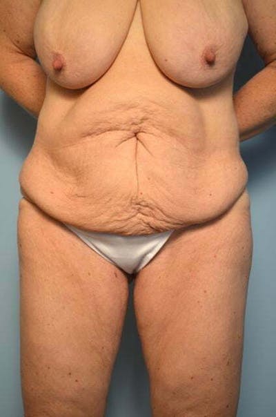 Tummy Tuck Before & After Gallery - Patient 119836 - Image 1