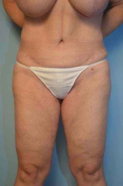 Tummy Tuck Before & After Gallery - Patient 119836 - Image 2