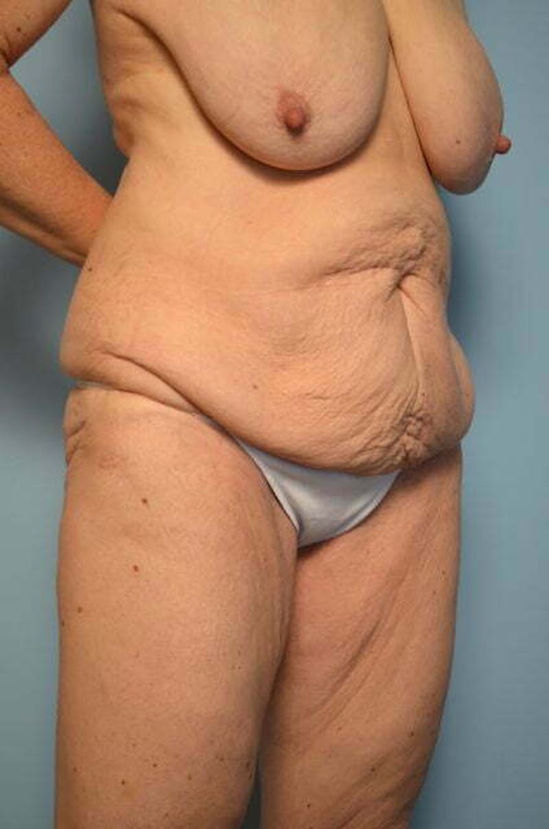 Tummy Tuck Before & After Gallery - Patient 119836 - Image 3