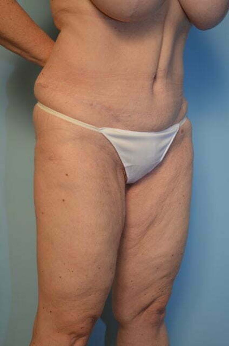 Tummy Tuck Before & After Gallery - Patient 119836 - Image 4