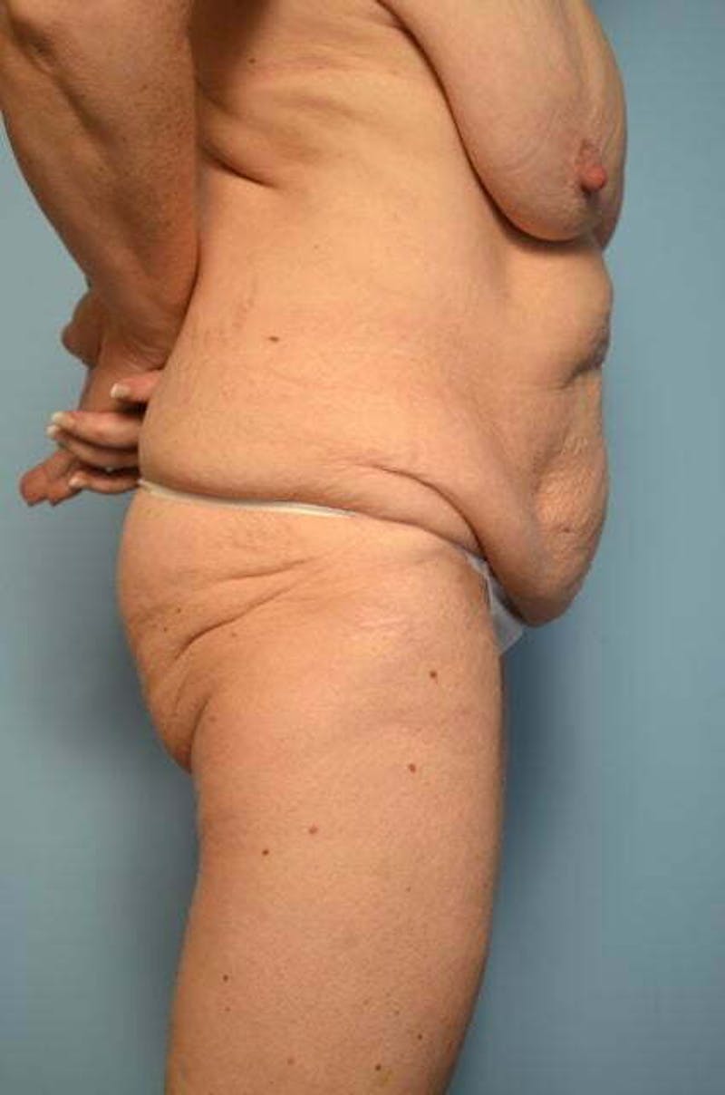 Tummy Tuck Before & After Gallery - Patient 119836 - Image 5