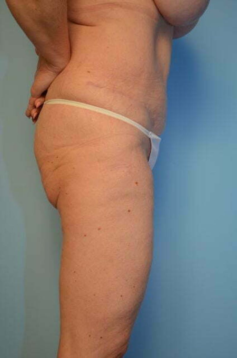 Tummy Tuck Before & After Gallery - Patient 119836 - Image 6