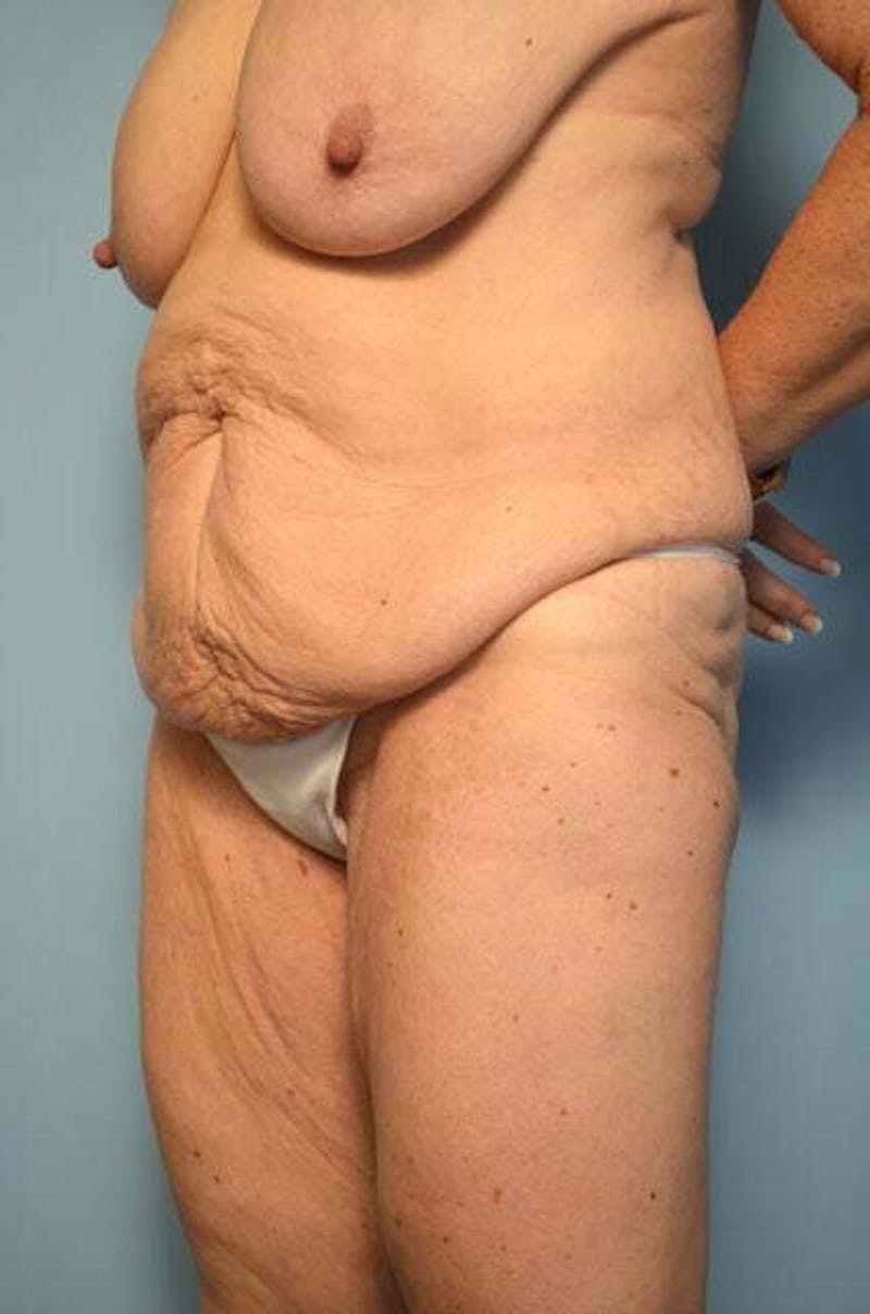 Tummy Tuck Before & After Gallery - Patient 119836 - Image 7