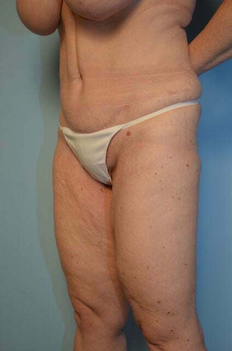 Tummy Tuck Before & After Gallery - Patient 119836 - Image 8