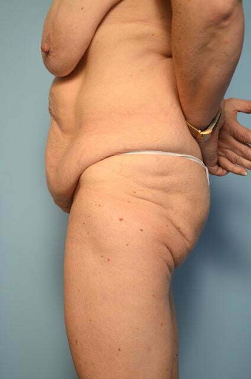 Tummy Tuck Before & After Gallery - Patient 119836 - Image 9