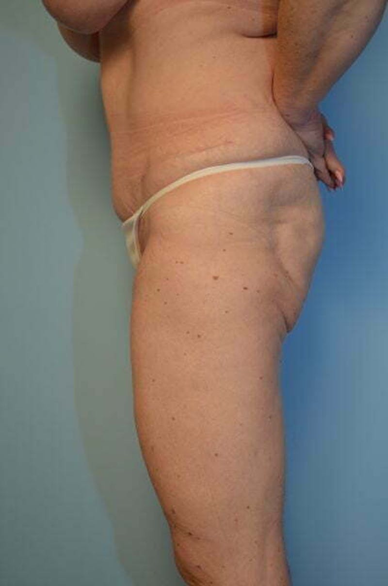 Tummy Tuck Before & After Gallery - Patient 119836 - Image 10