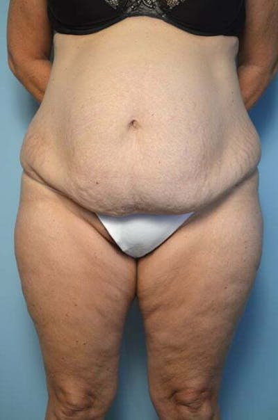 Liposuction Before & After Gallery - Patient 172464 - Image 1
