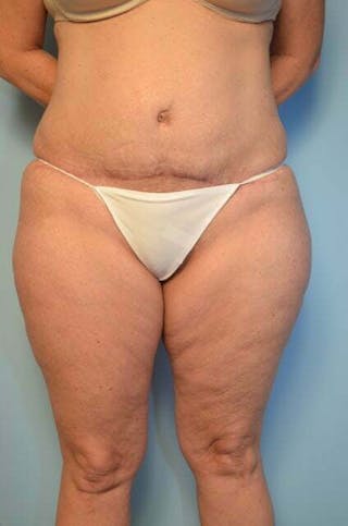 Liposuction Before & After Gallery - Patient 172464 - Image 2