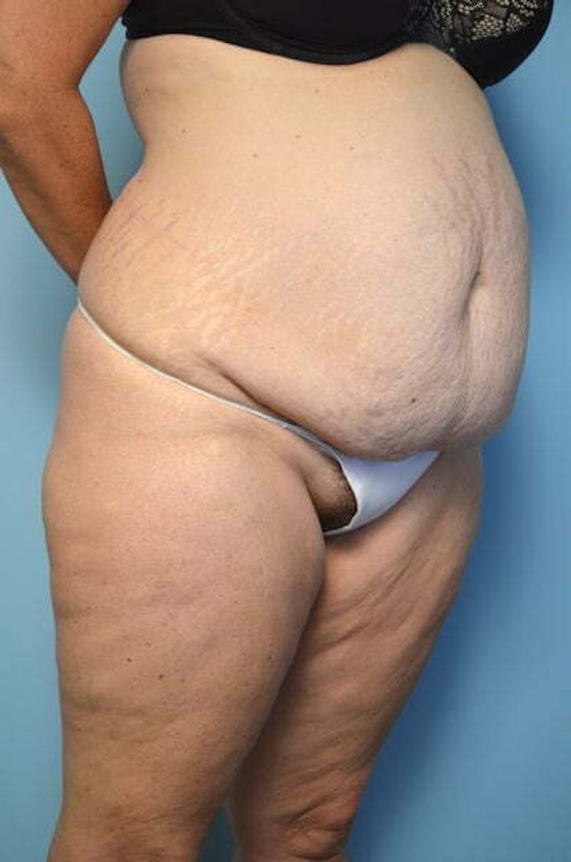 Liposuction Before & After Gallery - Patient 172464 - Image 3