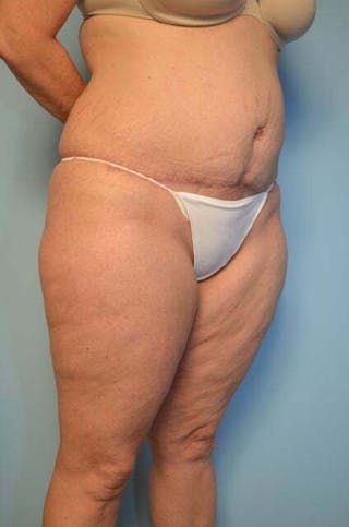 Liposuction Before & After Gallery - Patient 172464 - Image 4